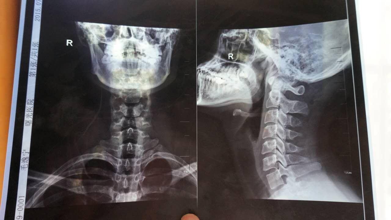 拍片的表现:颈椎生理弧度尚可,序列整齐,颈4-6椎体边缘略变尖.