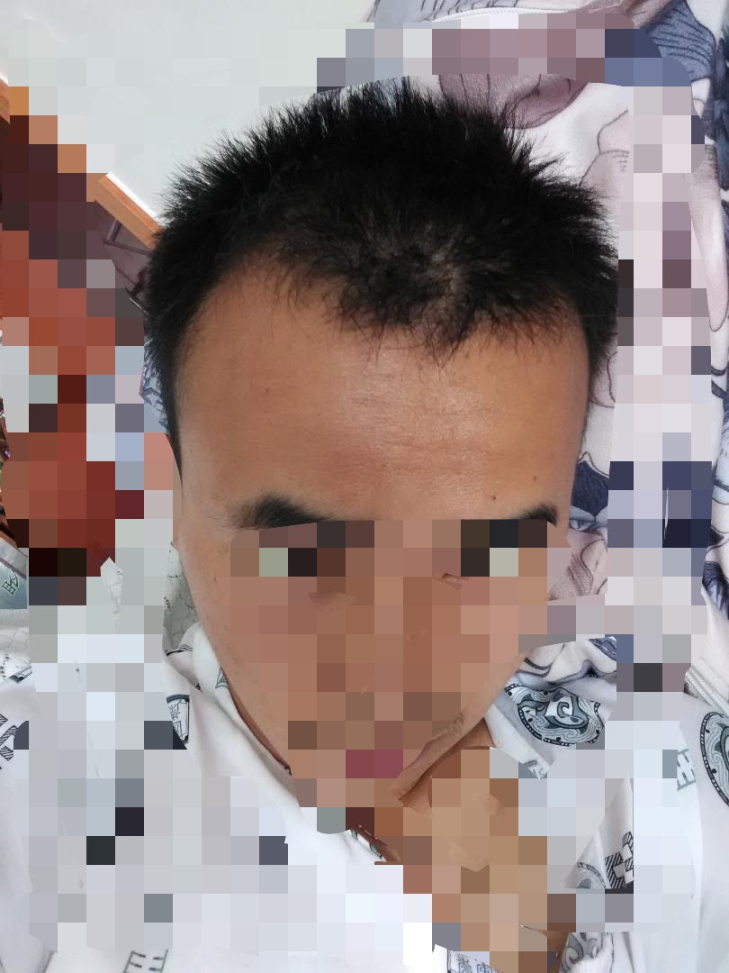 <em>男生</em>,M型<em>发际线</em>,<em>额头</em>高,应该选什么<em>发型</em>啊? - 头