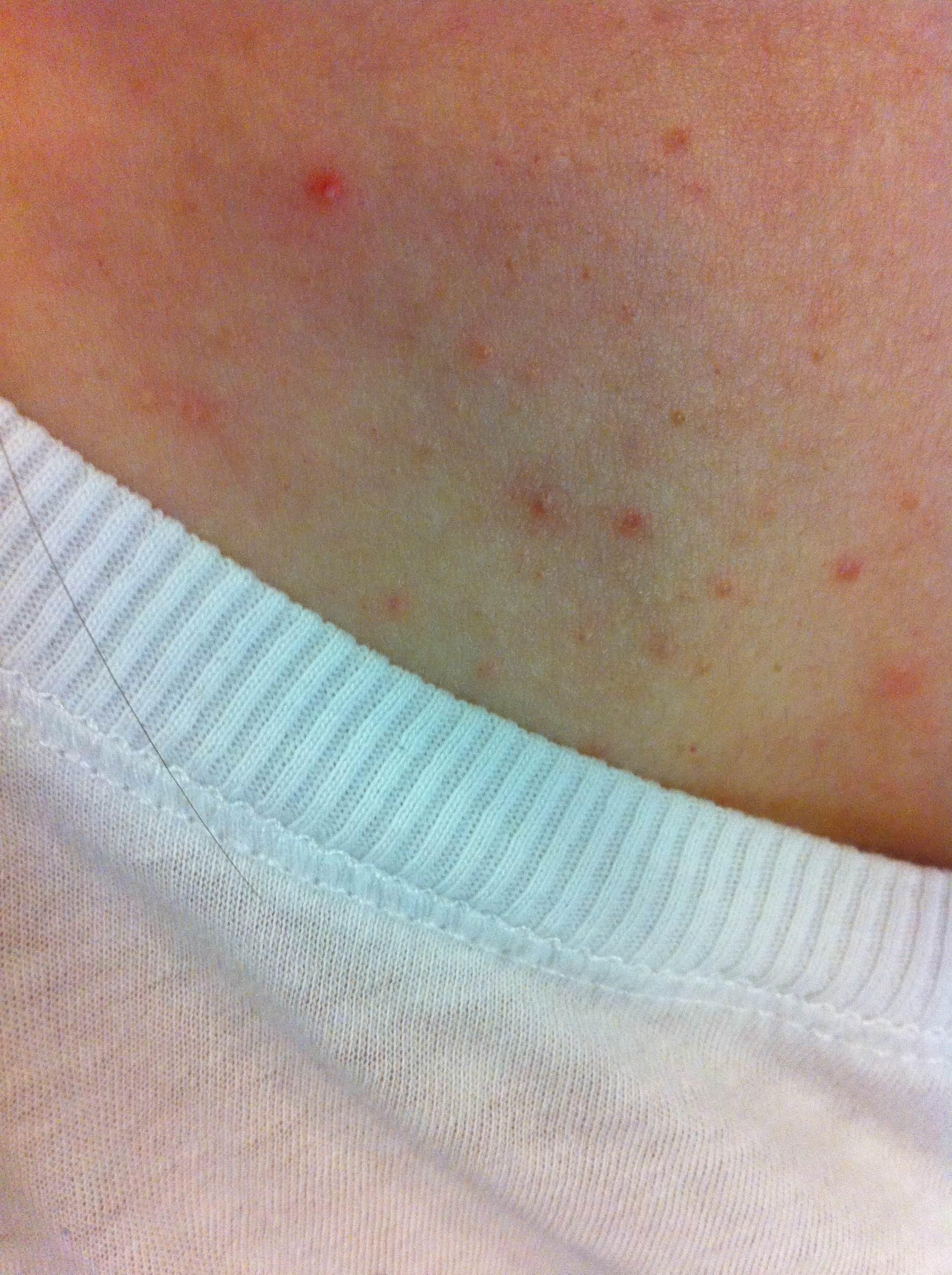 胸前和背上长的是痘痘还是毛囊炎?
