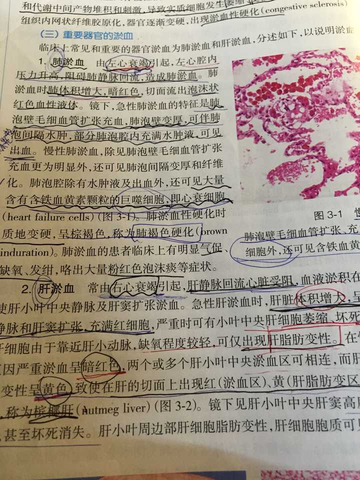 肺淤血和左心衰两者联系?