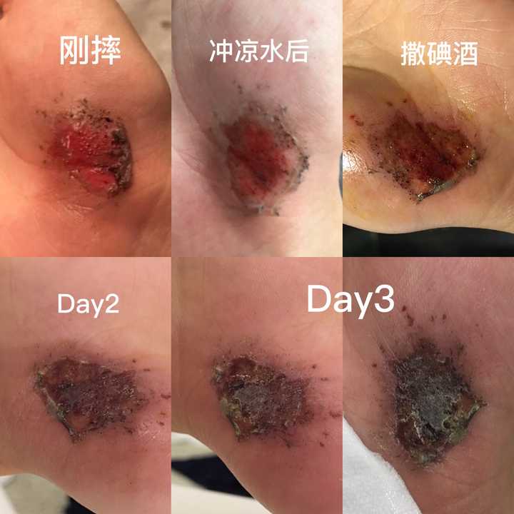 皮肤破后,流血结痂愈合是一个怎样的过程?