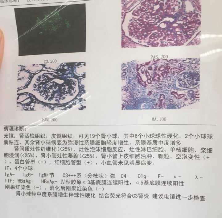 病理检测肾小球肾炎,结合荧光符合c3型,是轻中度的系膜增生型伴有硬化