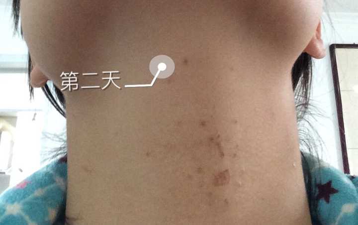 怎么治疗扁平疣?