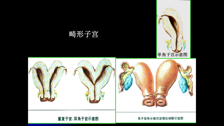 这是一些畸形子宫图片,看看就好,别放心上.