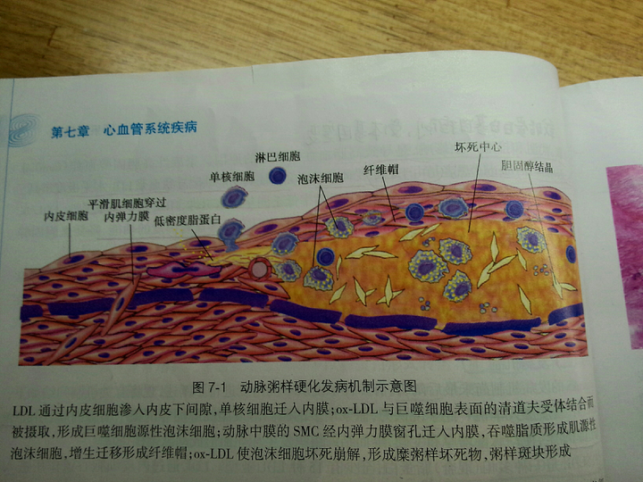 动脉粥样硬化的发病机制尚未阐明,目前有五个学说:脂质渗入学说,损伤