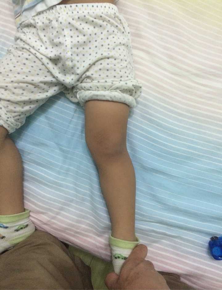 宝宝一岁之前都是o型腿,3-6岁是x型腿,这种说法是真的