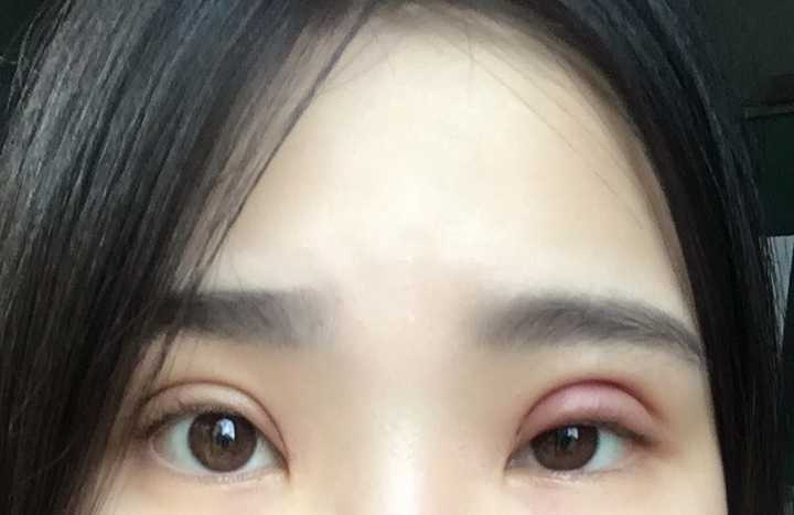 割双眼皮有什么危险吗