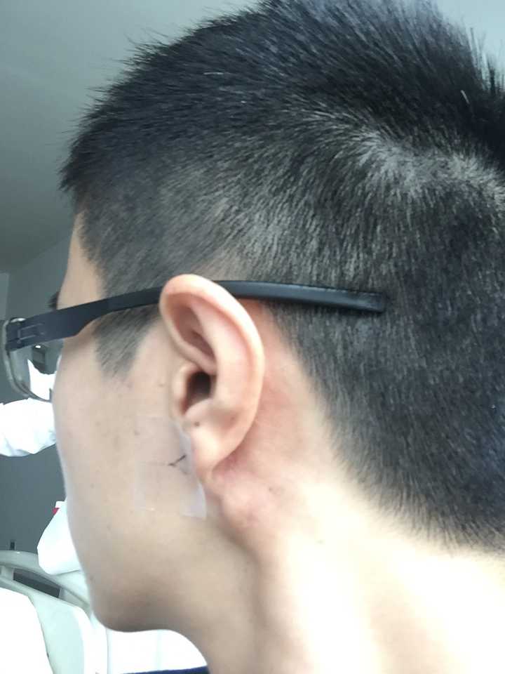 耳朵后面长了个包,医生说是皮脂腺囊肿,不想开刀,有没