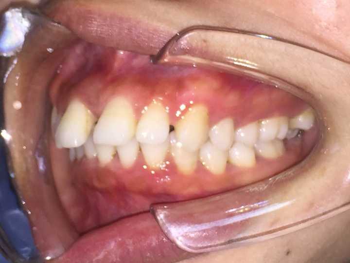 牙医们请看看我的牙齿咬合问题,我咬门牙,后面的牙咬合不起来,咬后面