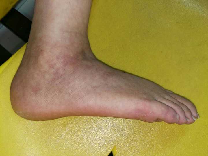 我右脚外侧脚踝扭伤已5个月,如今还有红色淤血,是什么