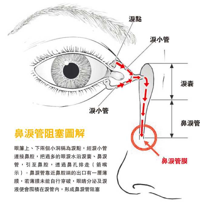 眼泪形成后进入泪囊,再由泪小管经泪点排出以湿润眼球,这就是正常流