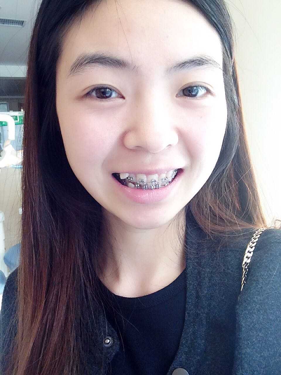 今天正式变钢牙妹了 医生最后决定收我一万
