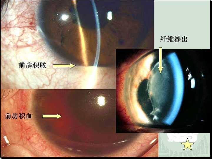 历史上的重瞳子是真实存在的吗两个瞳仁在眼睛里是如何分布的