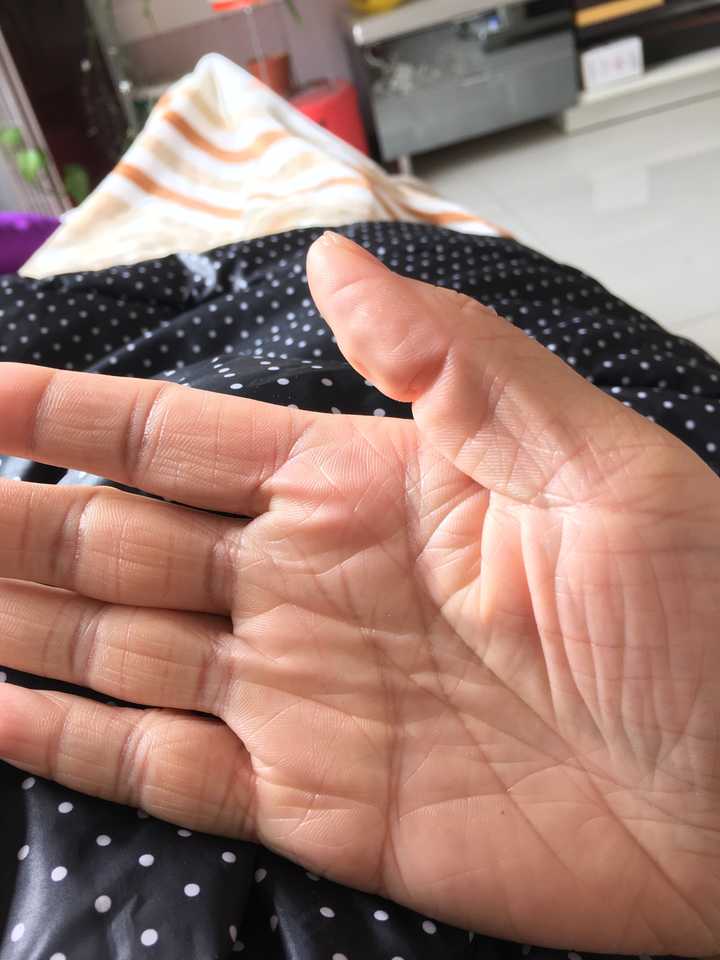 遗传性的皮肤干燥 手上全是死皮 脚上也是 一到冬天脸就脱皮 腿上也是