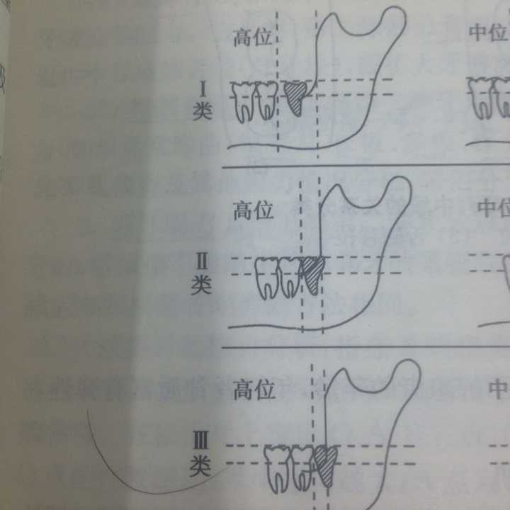 根据阻生牙在颌骨内的深度可分为高中低,根据阻生牙长轴与第二磨牙长