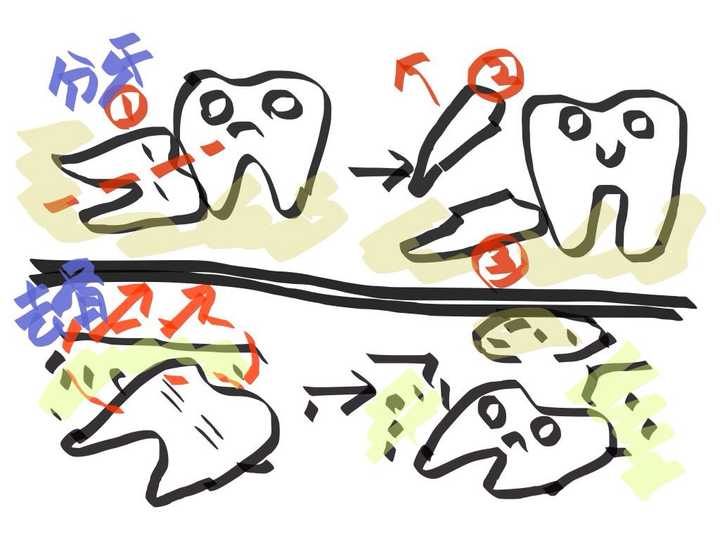 为什么拔智齿要用锤子砸 知乎