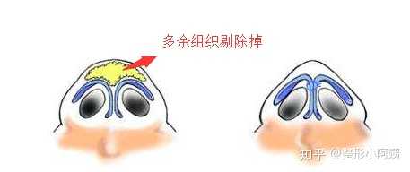 2,鼻翼软骨.