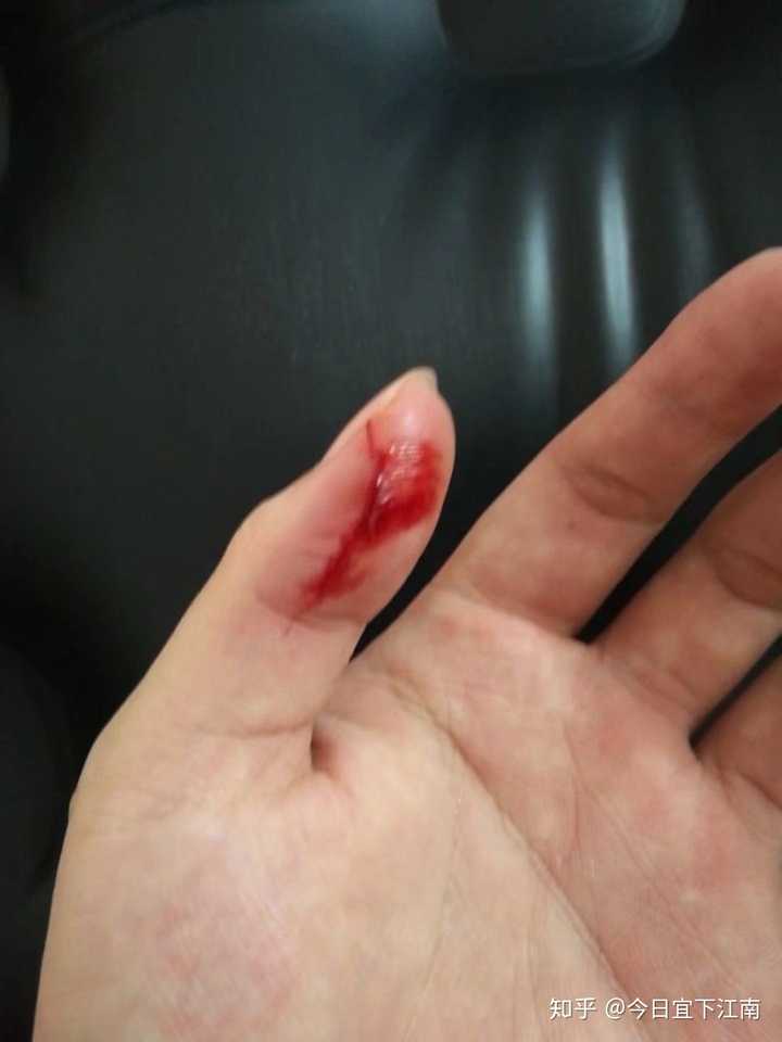 平时手指被割伤应该怎么处理