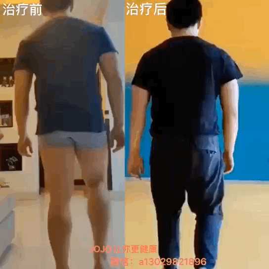 驼背和脊柱侧弯的区别在哪儿?纠正方法有什么不一样吗