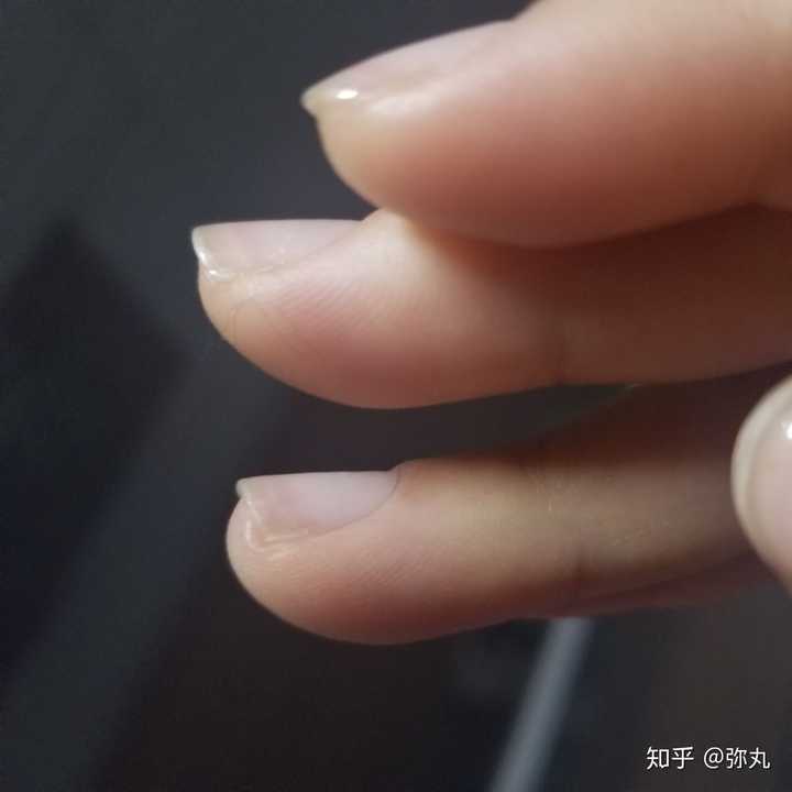 指甲翘起,是先天的吗?