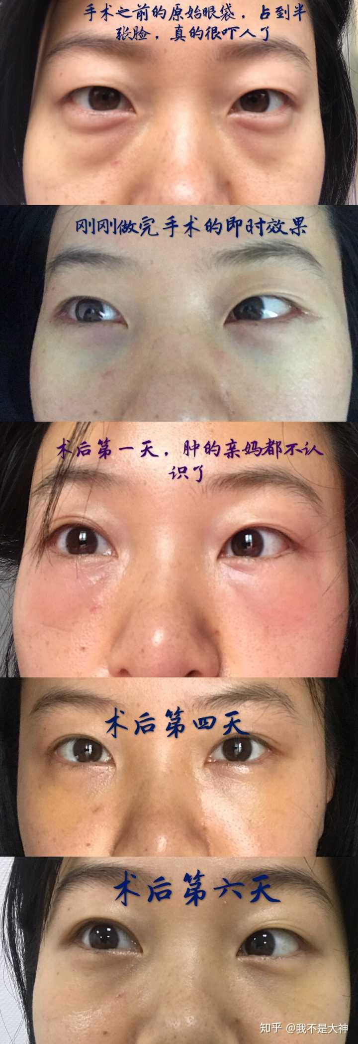 内切去眼袋怎么样