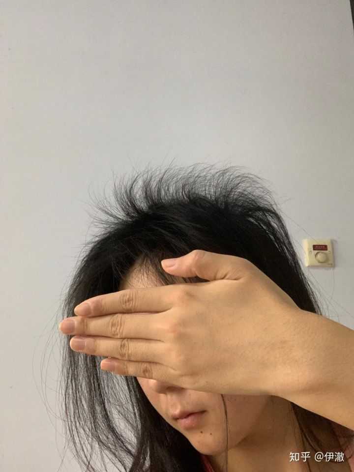 23岁女生狂脱发,怎么能快速生发?