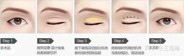 脂肪及松垂皮肤,然后将眼睑皮肤固定在所需高度上进行缝合,形成双眼皮