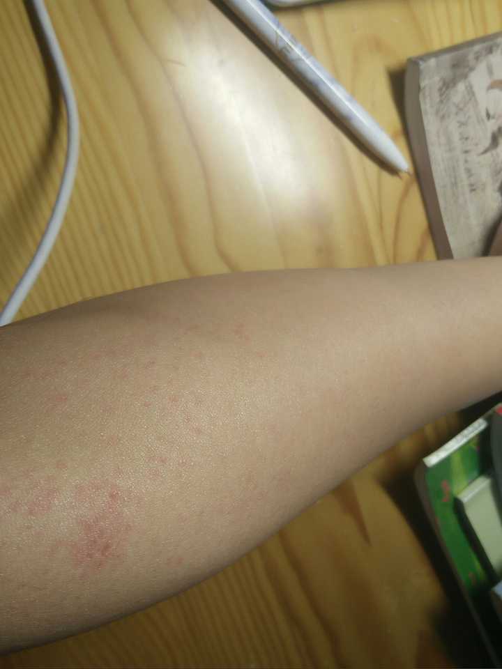 被脱毛膏灼伤该怎样维权?