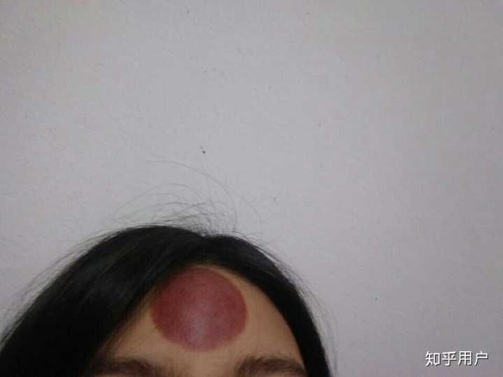 额头可以拔罐吗?