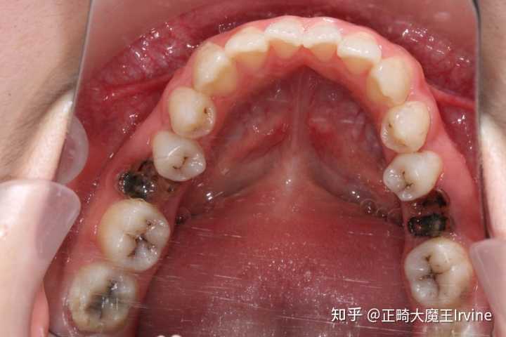 图中多个牙表面发黑形成龋齿,还有两个因龋齿导致牙冠破坏形成残根)