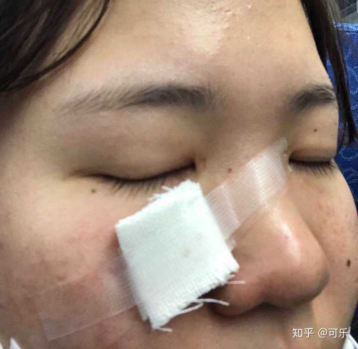手术祛痣切痣是什么体验?