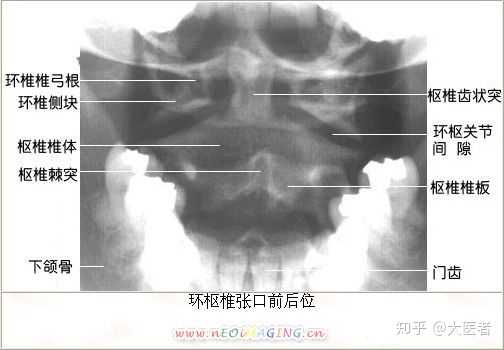 正常的寰枢关节间隙等宽