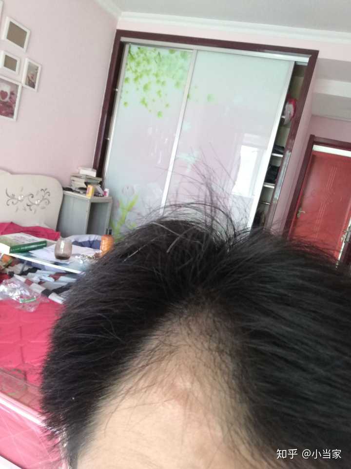一般长出来的绒毛多长时间能长成头发?