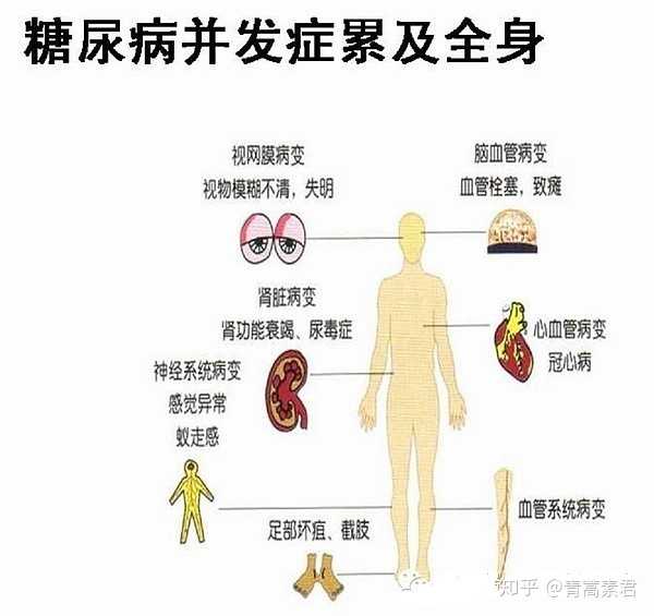 到底是什么糖尿病并发症带走了我的姥姥?