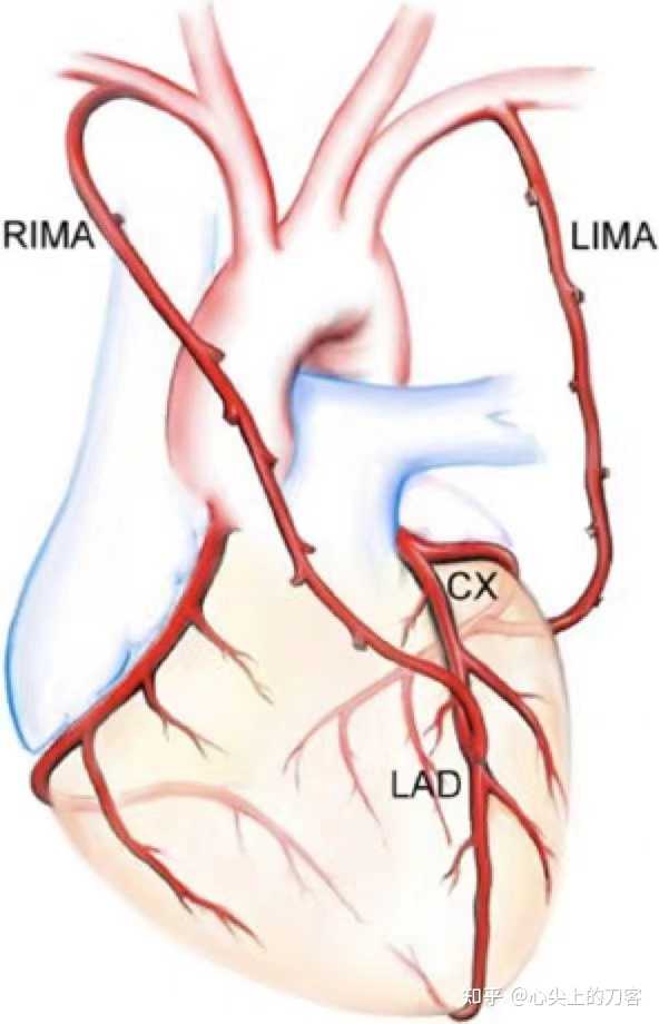 心尖上的刀客 的想法: 搭桥手术需要多个桥血管时,第