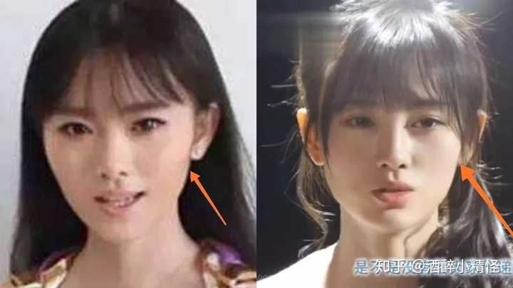 鞠婧祎真的整容了吗?