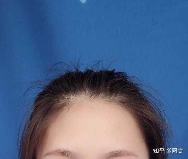 头发握起来感觉是没有变厚,但是我觉得真正的秃头女孩早就已经不在乎