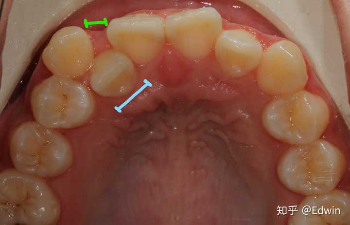 蓝线段:内陷牙齿的宽度;绿线段:牙列存在间隙的宽度.