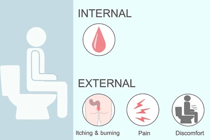 如果你怀疑自己有痔疮,了解此疾病的症状非常重要.