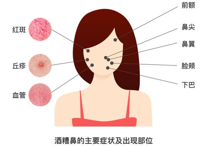 寻常痤疮往往由于油腺导管堵塞,导致面部黑头和粉刺.