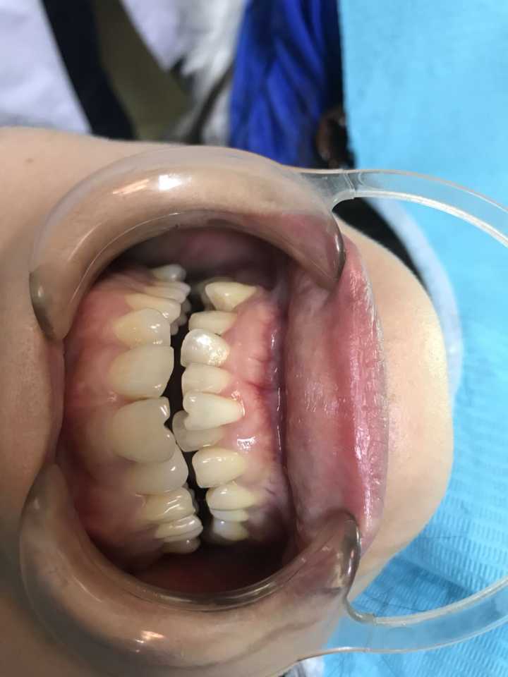 没拔牙齿之前拍的,张牙舞爪的,大门牙被挤得猛往前突,本来就嘴突,以致