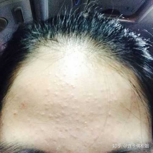 干皮化妆,在额头,鼻翼两次八字区特别容易长闭口