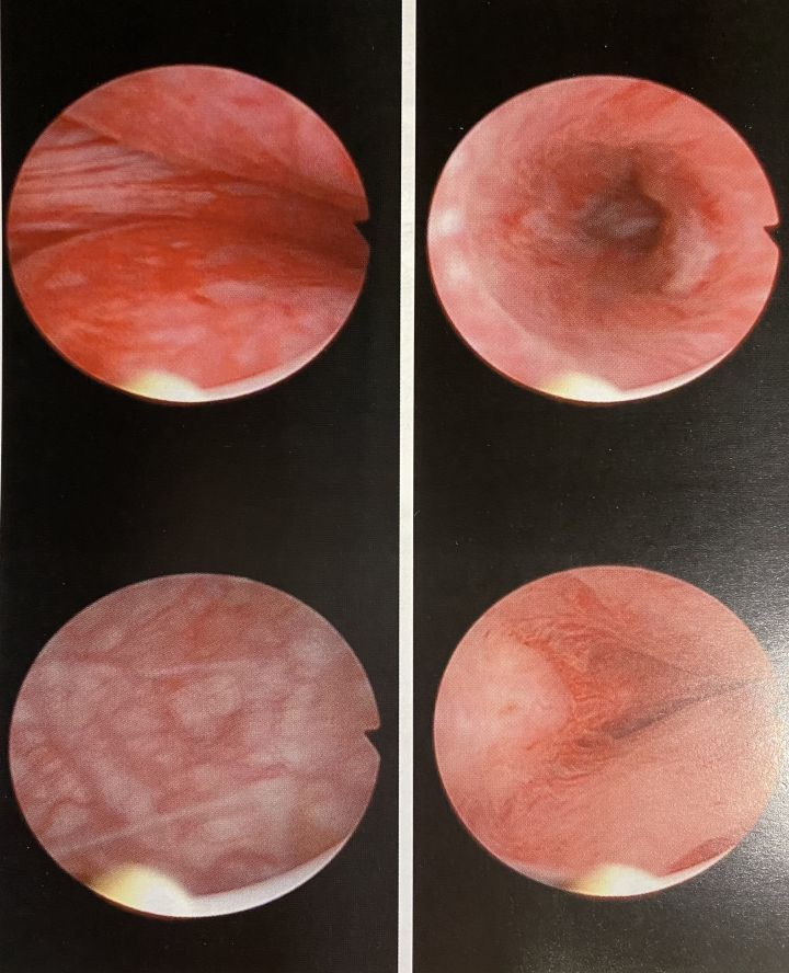 前列腺增生剜除手术技术成熟了吗