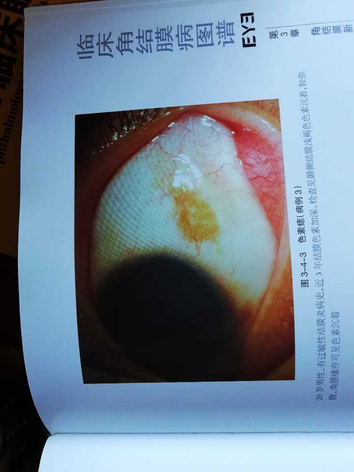 眼球有褐色斑点,是什么原因?