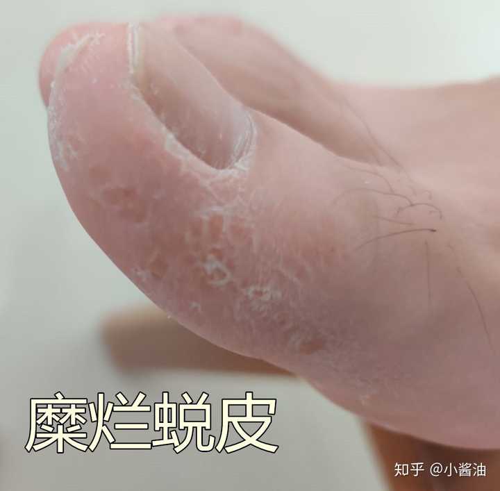 水疱型脚气水泡能扎破吗?