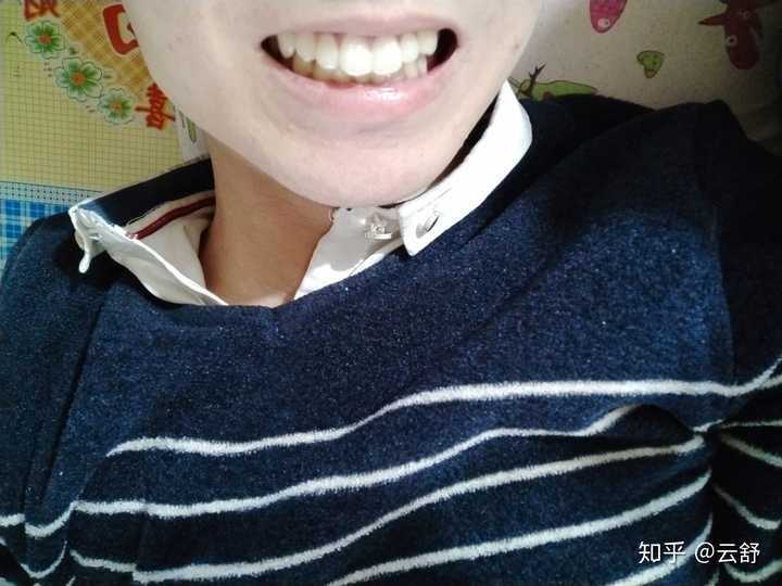 拥有一口龅牙是什么体验?