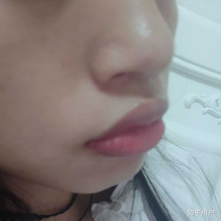 上嘴唇上翘,上翻怎么办?侧面看起来简直丑哭我!