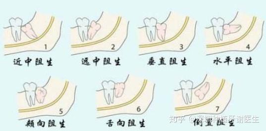 有一些正位的智齿,它的拔牙过程也比较轻松,手术也比较简单,它的费用