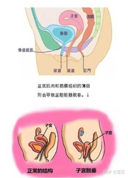 " 女性盆地由封闭出口的多层肌肉和筋膜组成,有尿道,阴道和直肠穿出