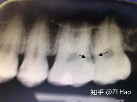 牙齿表面根本看不到有龋齿,在x片辅助检查下发现在牙颈部有邻面龋齿.